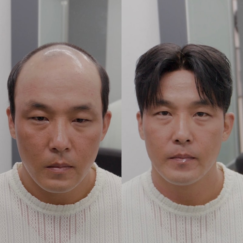 부산 남자가발 전문 30대40대 자연스러운가발