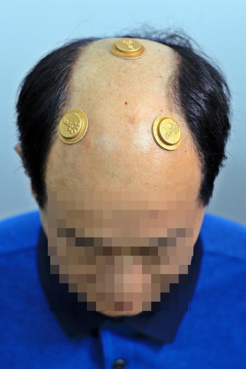 자석가발 후기 올려봅니다.