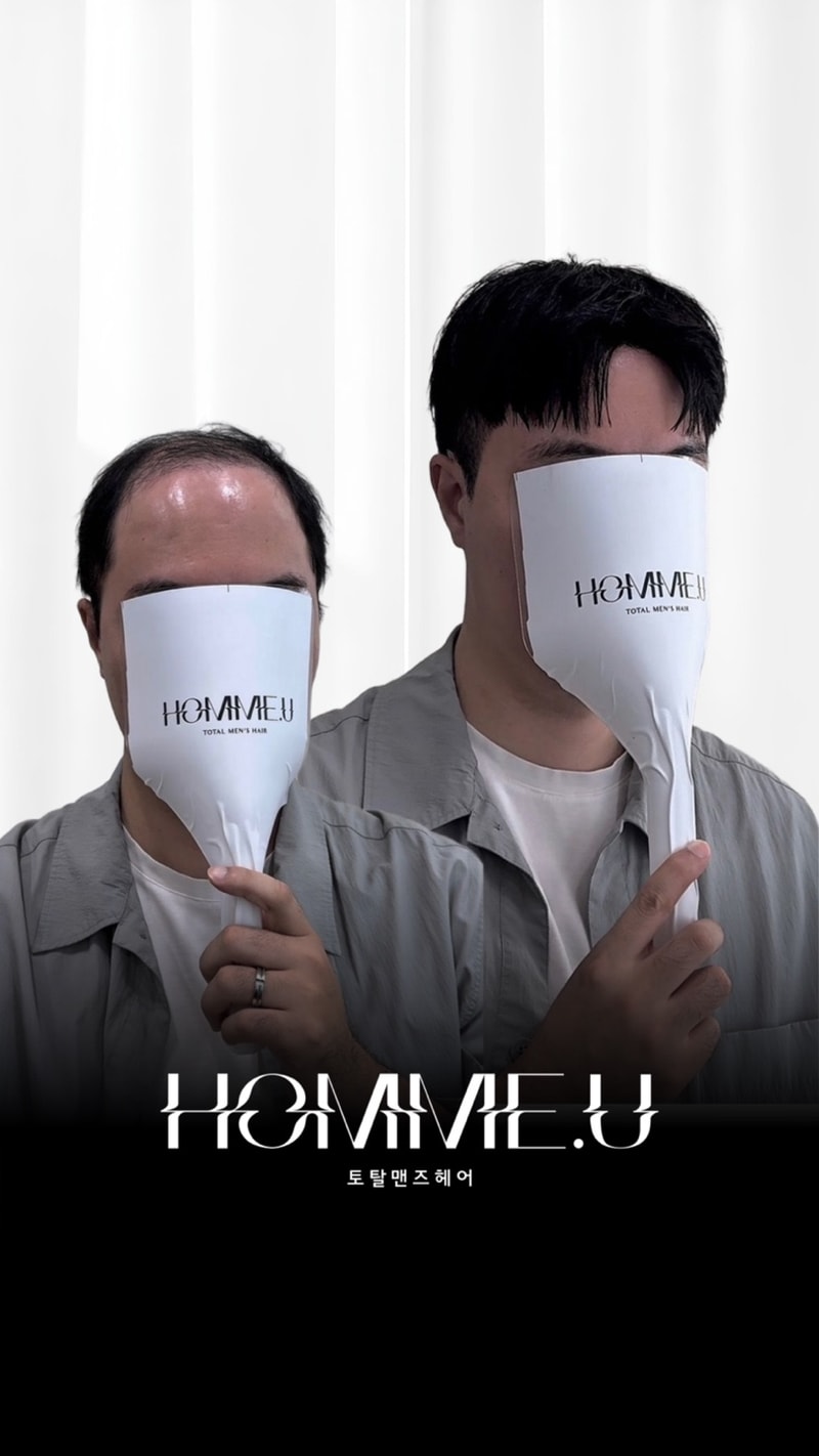 일산 남자 정수리 가발