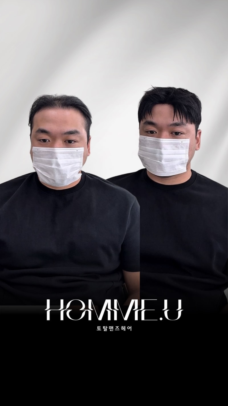 일산 남자 정수리 가발