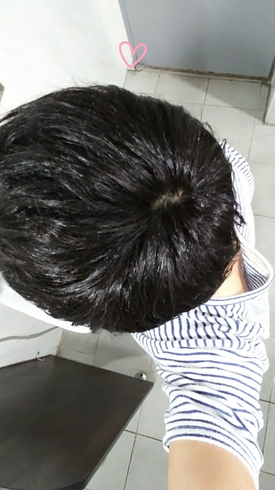 애프터 정수리.jpg