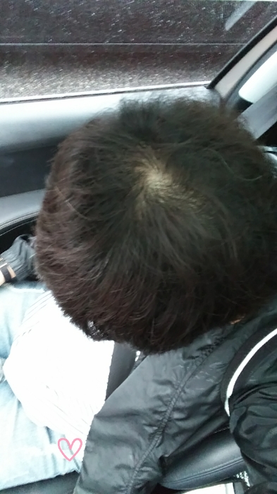 비포 정수리.jpg