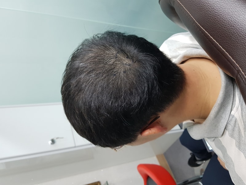 측면2 증모 전.jpeg