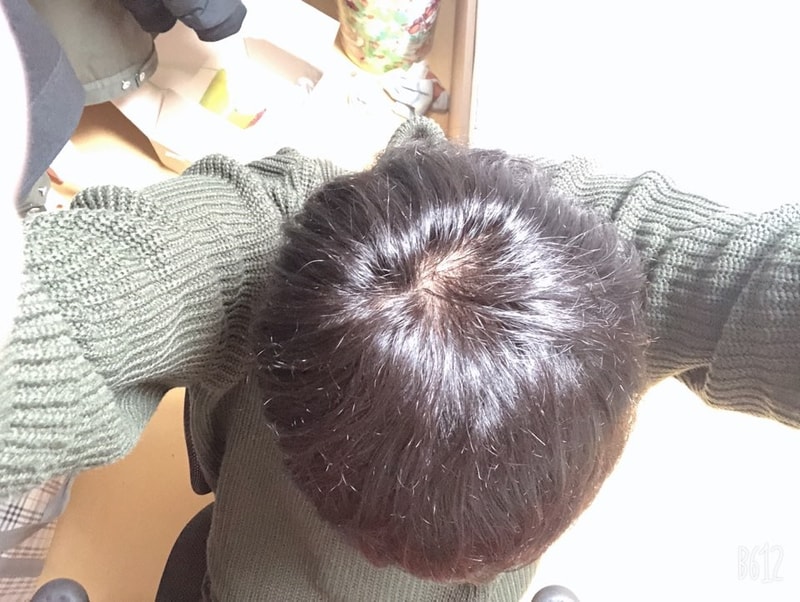 위쪽 정수리1.jpg