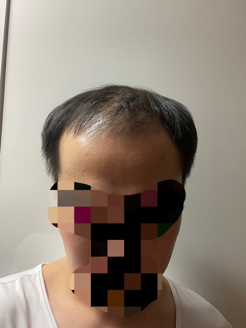 가발 생활 3년반째. 드디어 두번째 가발을 맞췄습니다.