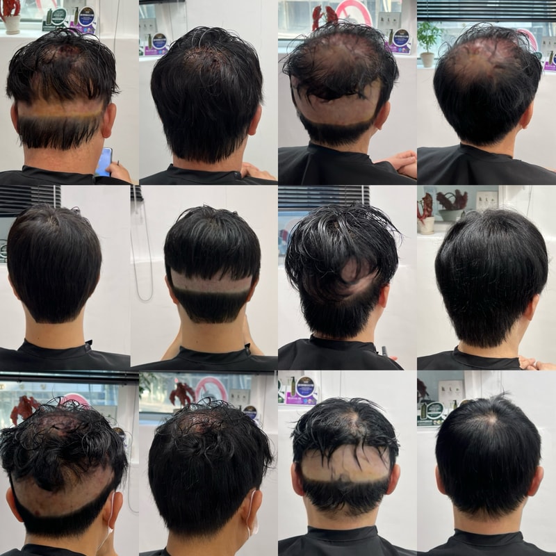 비절개 모발이식 삭발