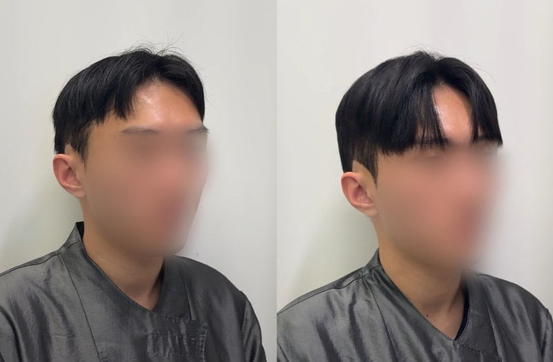 증모술로 숱도 길이도 늘려보세요~