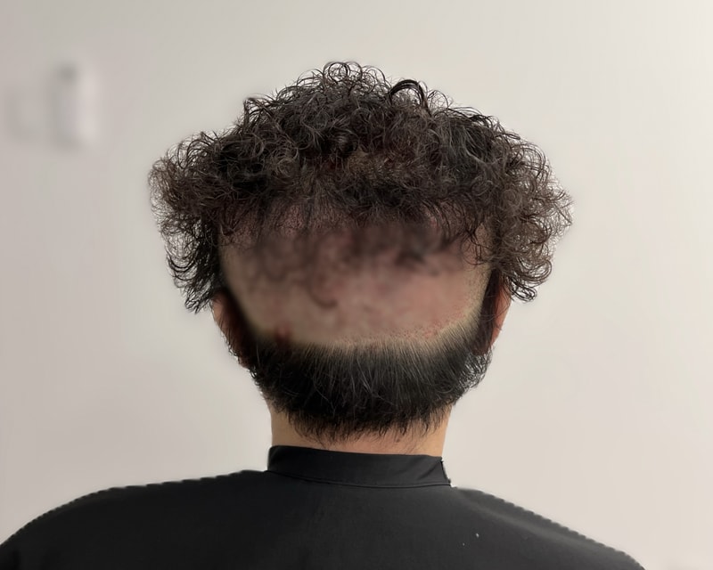 비절개 모발이식 뒷머리 삭발 가리는 방법.