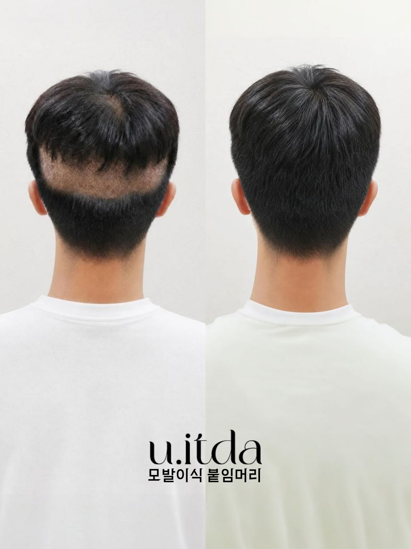 광주 모발이식 후 붙임머리