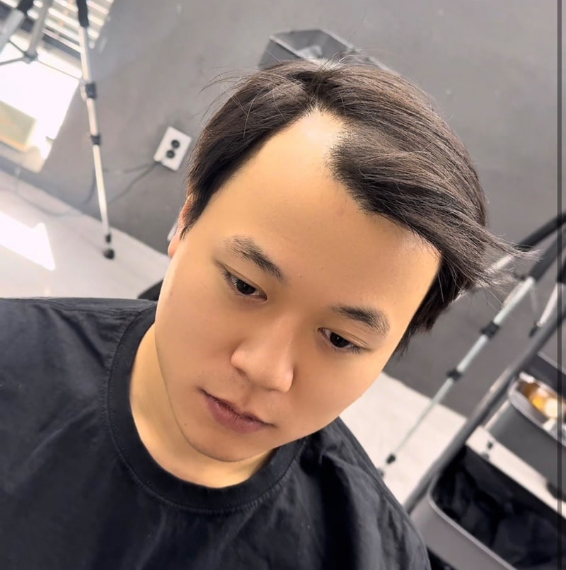 탈모는 가발 스왈로펌만이 답이 아니다!!!