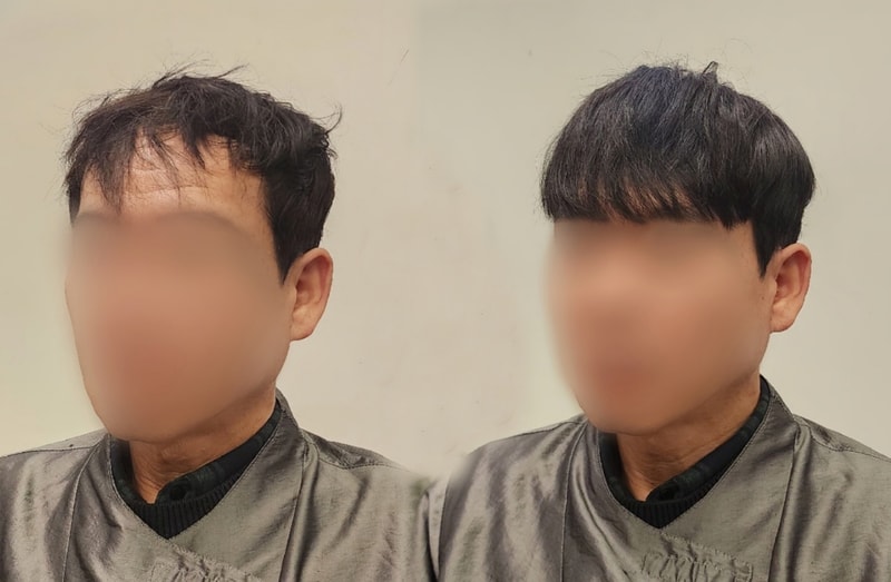 증모술로 몇년 어려보일까요~?
