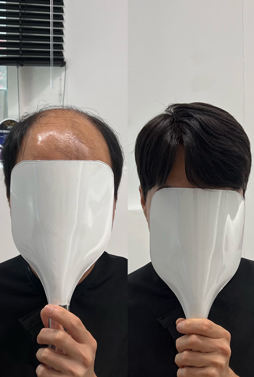 남자 부분 가발 전후