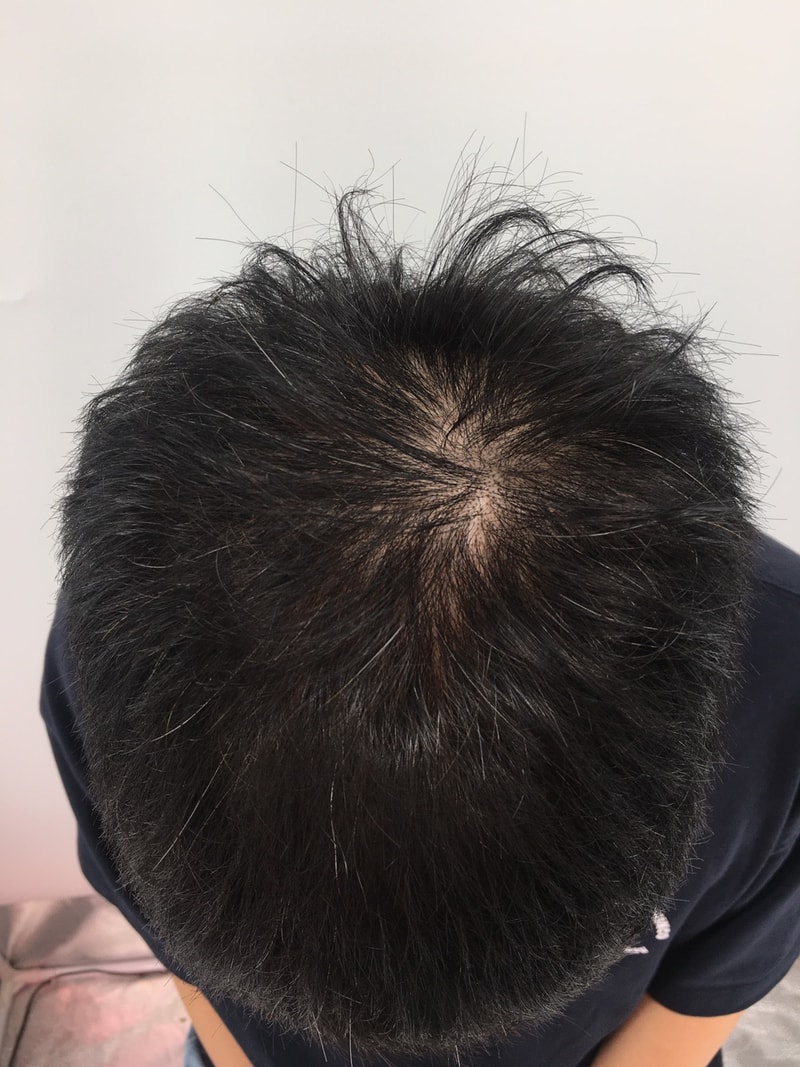 뉴헤어 주사치료후10개월후_2406.jpg