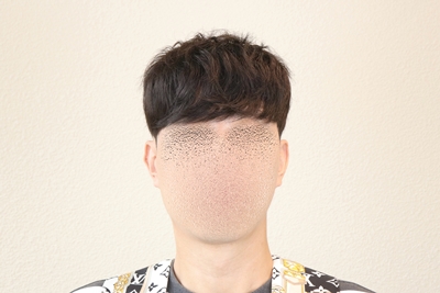 모발이식수술 후 모발이 생착되어 자라기 전까지  흉터를 가리기 위해서 착용한 가발