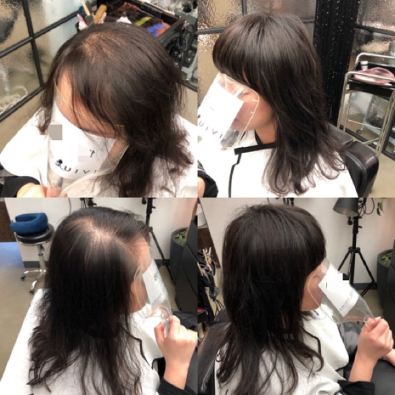 20대 탈모 쿠션증모술 성공사례