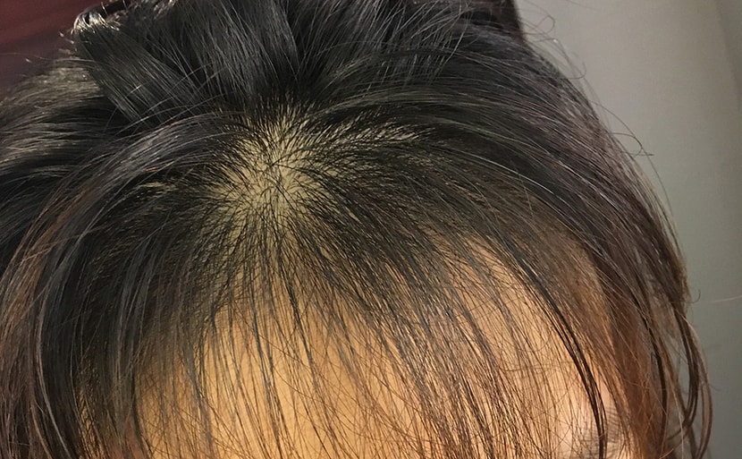 친구가 탈모냐고 놀랐지만.. 원래 어렸을때부터 앞머리숱이 이랬어요 