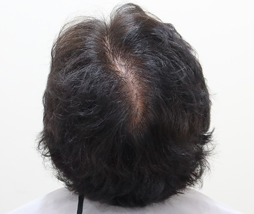 대구탈모치료병원 모모 대구점에서 정수리 3000모 이식 받고 10개월 지나 많이 좋아졌어요