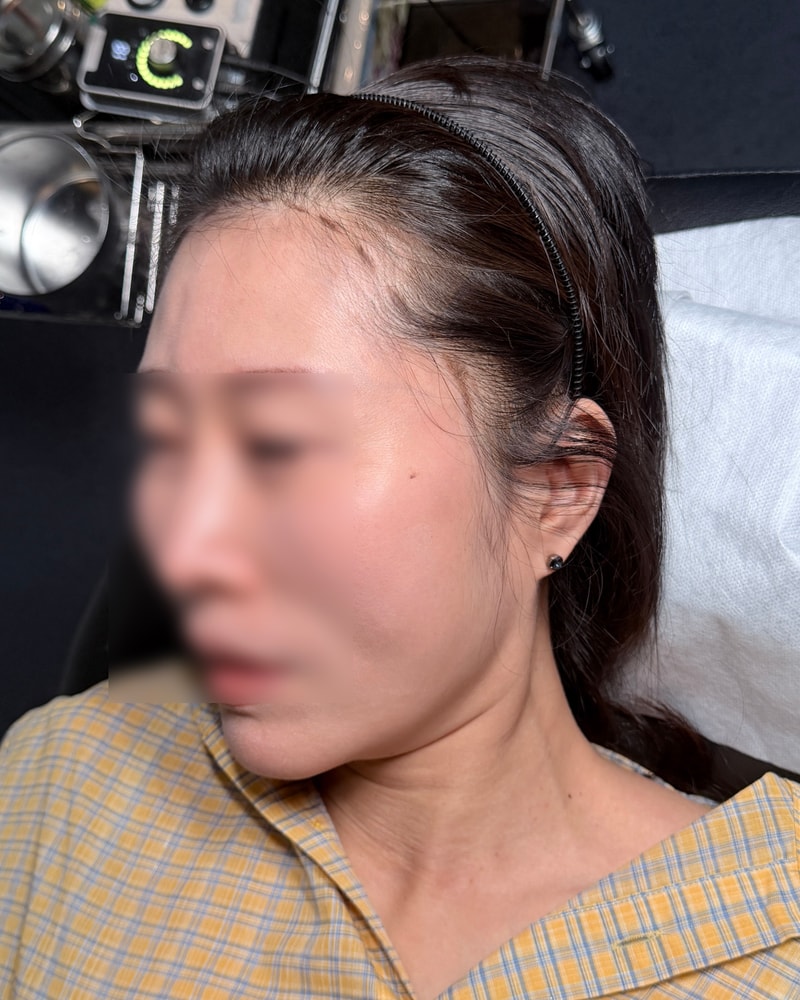 헤어라인 후기 남겨요