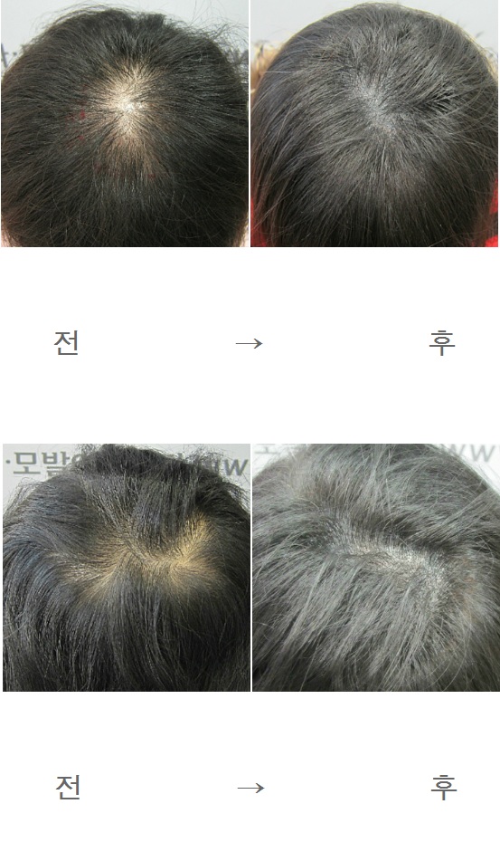 엄마두피색소사진.png