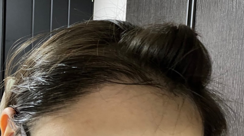 4. 수술후_6개월_셀카2.jpg