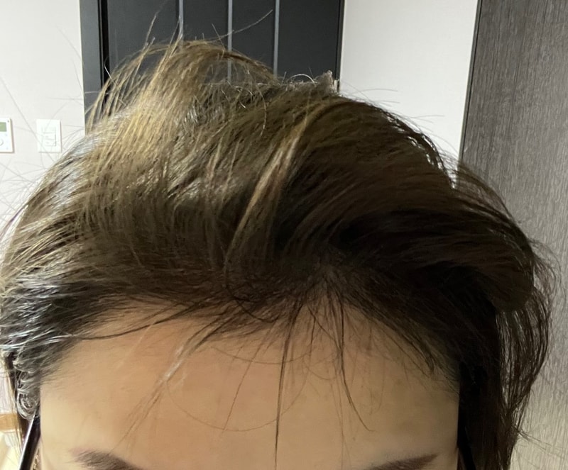 4. 수술후_6개월_셀카1.jpg