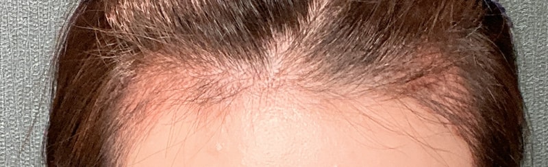수술-후-30일-정면.jpg