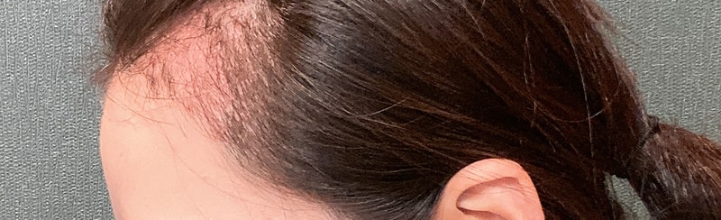 수술-후-30일-측면.jpg