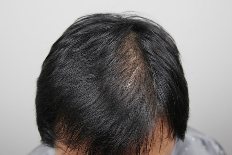 피부과 전문의 김대우 원장에게 정수리 모발이식 받았습니다!