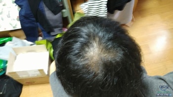 복용 초기(아마도 쉐딩)