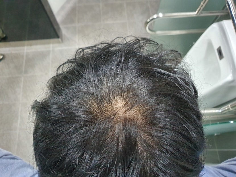 1년4개월 약먹은지 조명밑