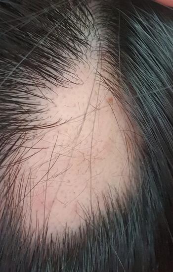 원형탈모 발견 시점 2달후 사진