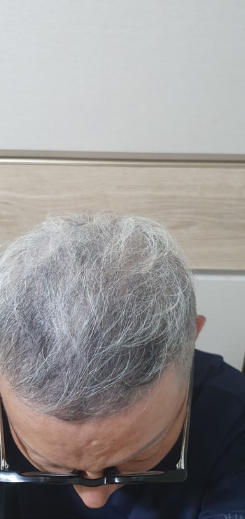 사이폴엔 치료 10개월차