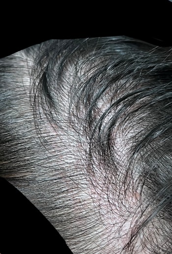 오른쪽 측두부2