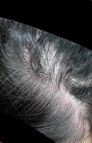 오른쪽 측두부1