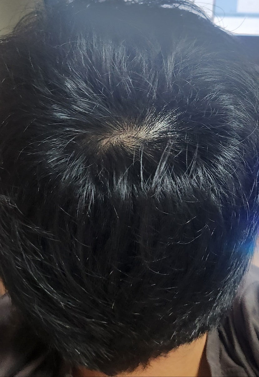 두타 정품 3개월 먹고 두타카피약으로 갈아타고 1개월