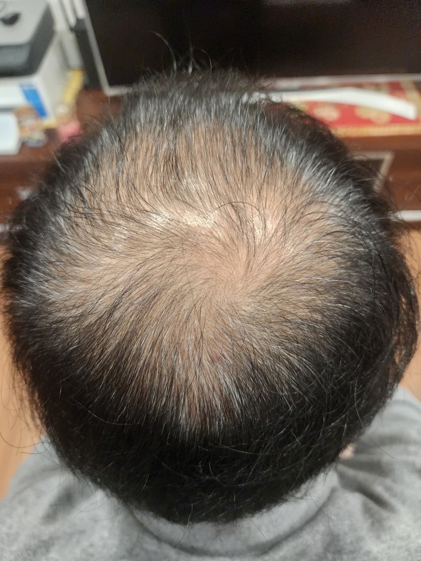 11.1일자 후기 잔머리가 눈에 띄게 생기기 시작, 모발도 전보다 많이 풍성해 보임 (흰머리 때문에 실제보다 덜 풍성하게 찍힘ㅠ)