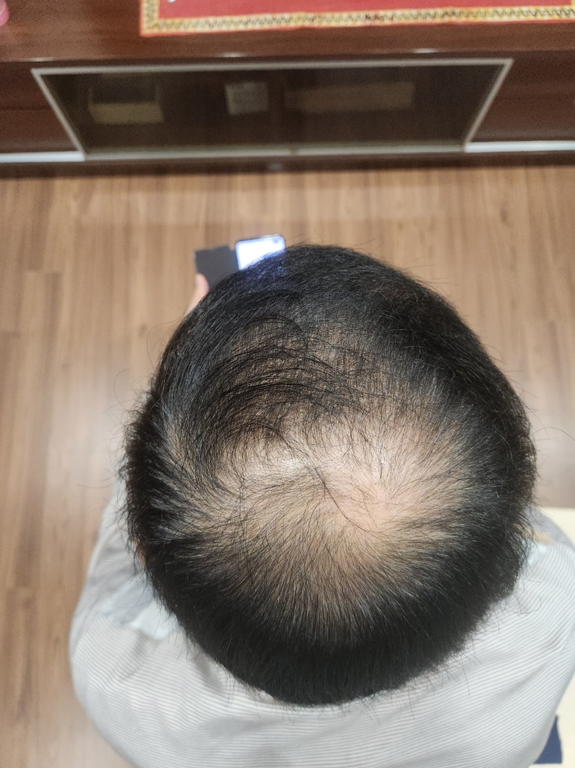 이것도 10.8일자 찍은 사진 모발이 매우 얇음