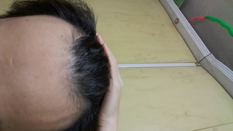 Hairfessia 7个月后换乘Abodot 3周左右服用后记