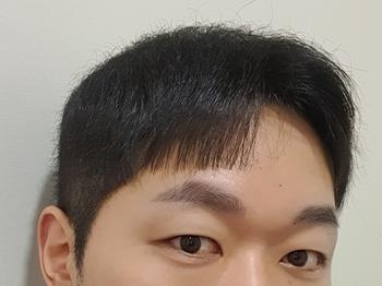 단독 미녹시딜정 995일차