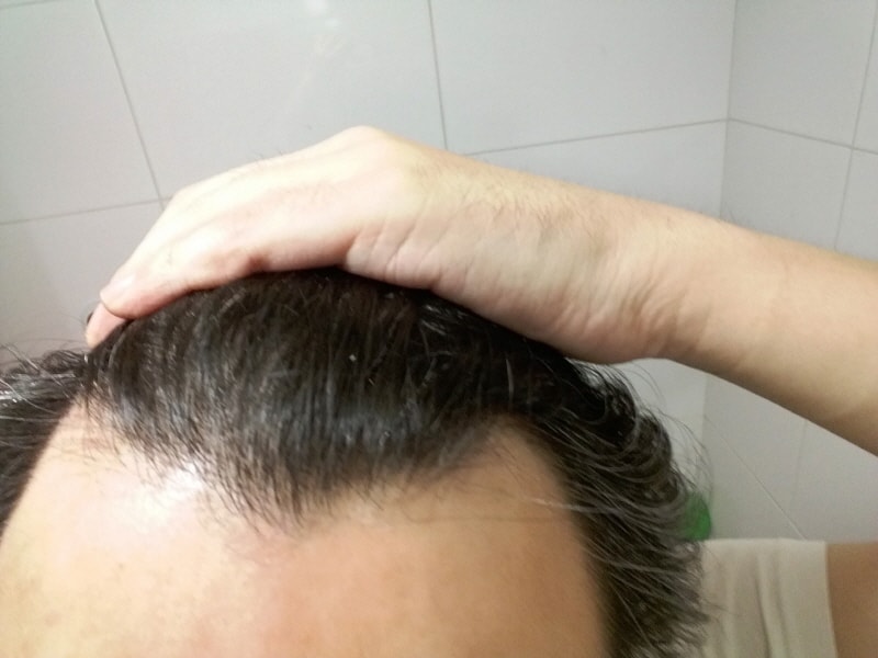 4월 머리 감기전 m자 (지루성 두피로 머리감기전엔 항상기름짐 ㅠㅠ)