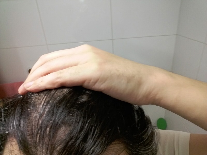 4월 머리 감기전 m자 (지루성 두피로 머리감기전엔 항상기름짐 ㅠㅠ)