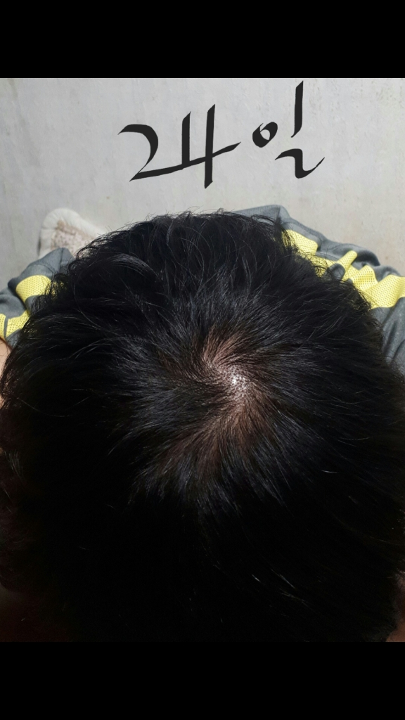 피나 138일차 아직 효과가 있는지 모르겠네요..