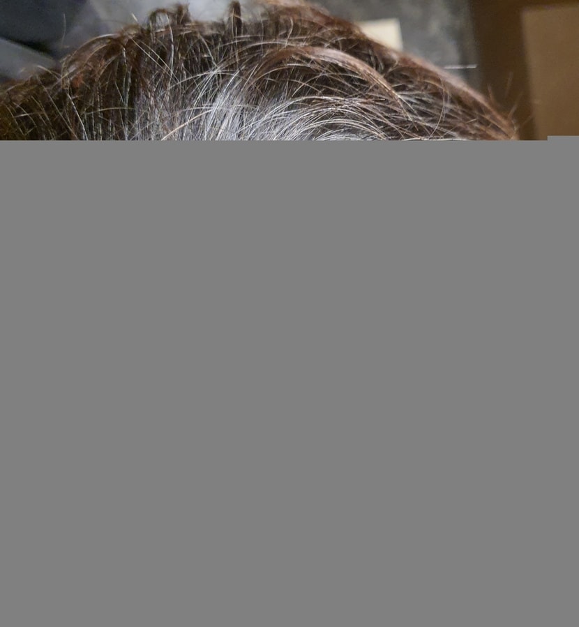 아보다트 3개월 복용