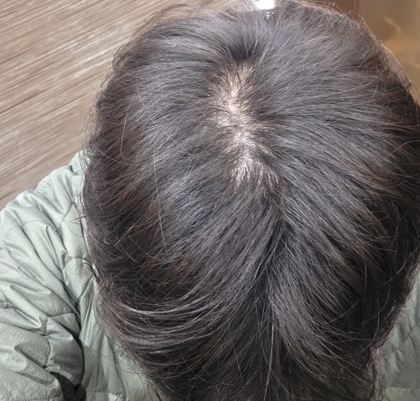 2달후 이때부터 얇은 머리카락이 보이고 부양력이 생김