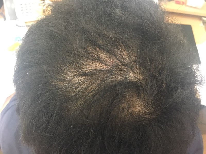 大家好 我们是Minoxidil(柯克兰)+ Abbotte后记