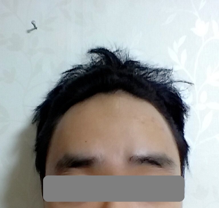 수술전