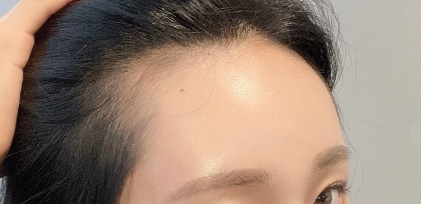 수술 전