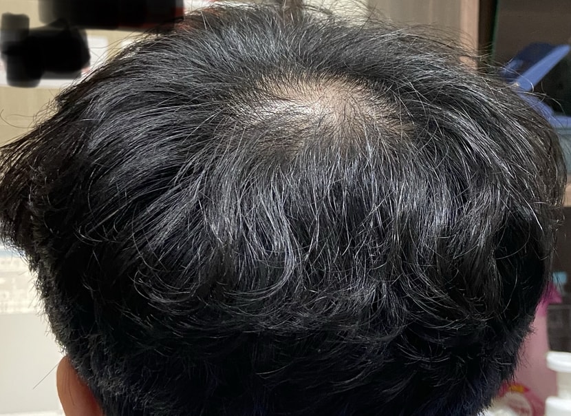 정수리 탈모