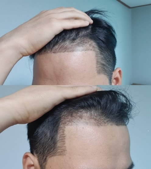 좌, 우 모발이식 필요 구역