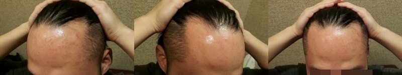 Hair transplant non-intersected 1600 hair follicles a week later